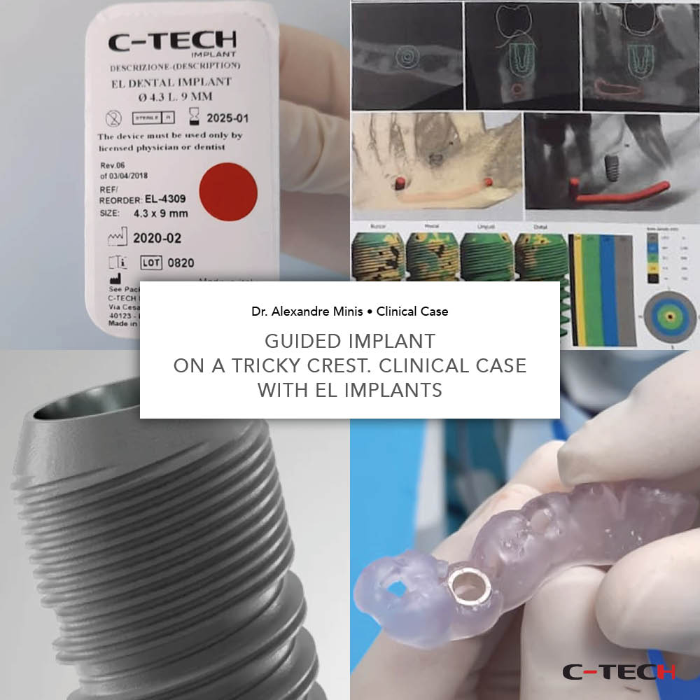 Guided Implant On A Tricky Crest Clinical Case C Tech Implant